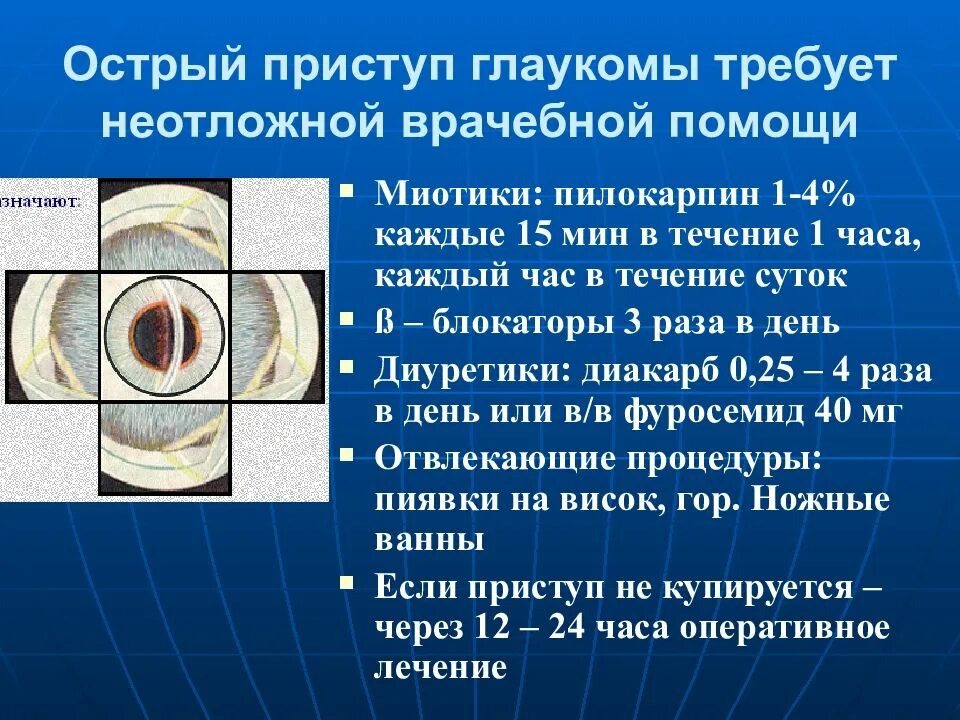 Стадии острого приступа закрытоугольной глаукомы. Острый пристуап локуума. Отстрвй присьуп гдаукоиаю. При остром приступе глаукомы зрачок. При глаукоме можно применять