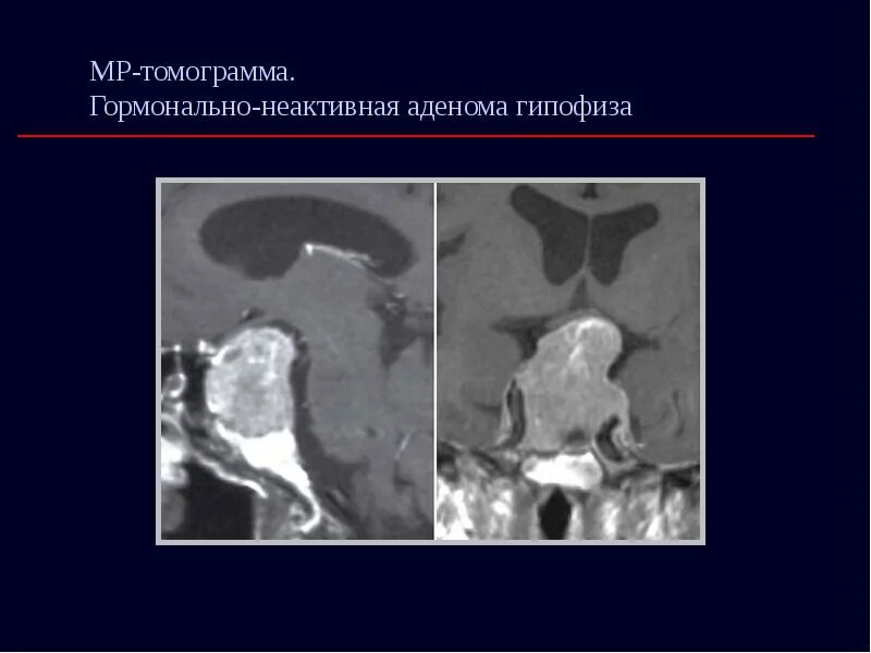 Воспаление гипофиза. Опухоли гипофиза патанатомия. инфраселлярный рост аденомы гипофиза. кортикотропная аденома гипофиза. аденома гипофиза патанатомия.