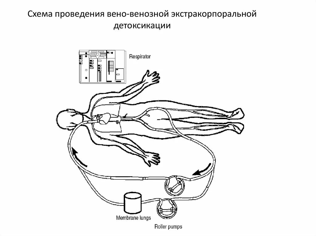 Гемофорез что это. Эфферентные методы детоксикации в хирургии. Экстракорпоральная детоксикация. Экстракорпоральные методы детоксикации. Методы экстракорпоральной детоксикации организма..