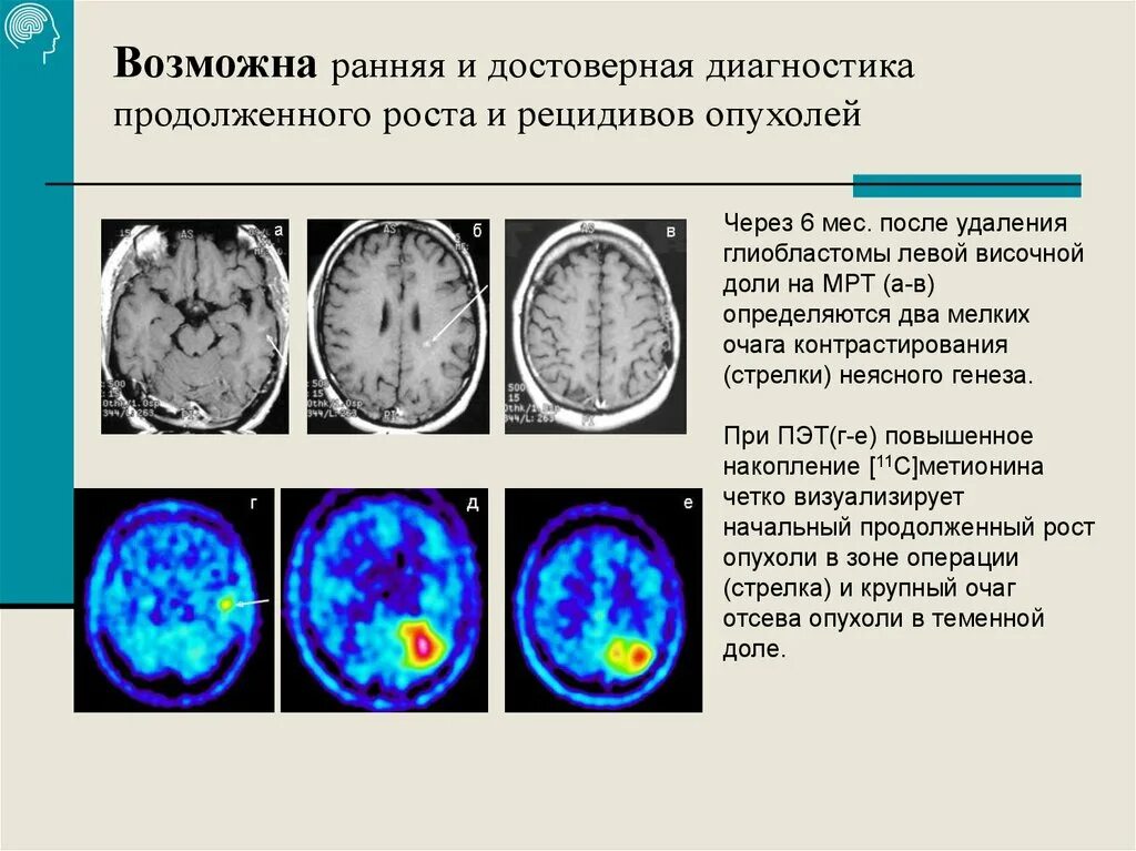 ПЭТ кт опухоли головного мозга. Опухоли мозга на ПЭТ кт. ПЭТ-кт глиобластома. Глиобластома височной доли мрт.