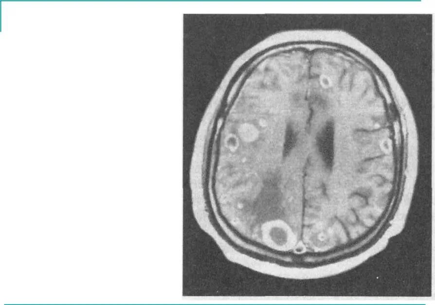 Лечение метастазов мозга. Метастазы головного мозга кт. Метастатические опухоли головного мозга. Многочисленные новообразования в головном мозге.