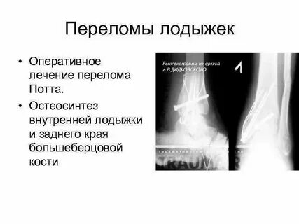 Закрытый перелом голеностопного