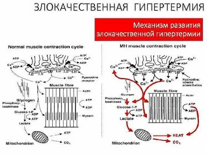 Злокачественная гипертермия это
