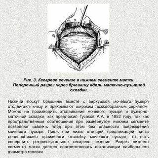 Сечение матки