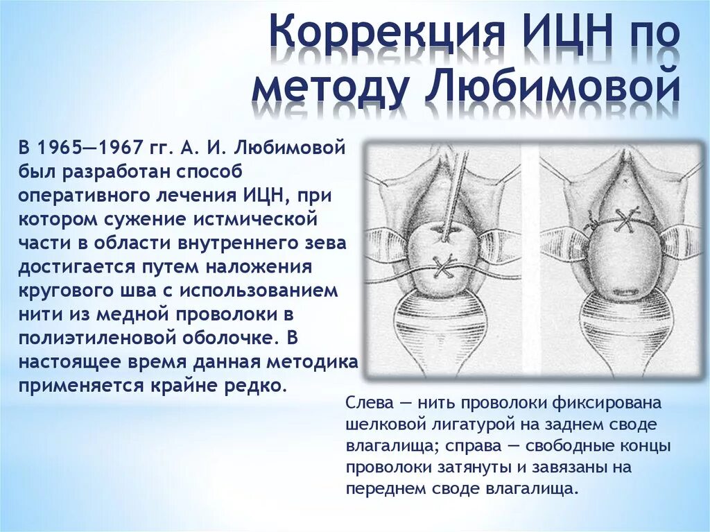 Шов по Любимовой на шейке матки. Шов на шейку матки при беременности методики. Швы при ицн