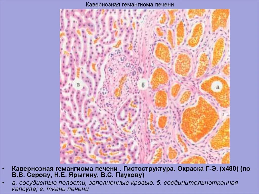 Печень микропрепарат описание. Кавернозная ангиома печени микропрепарат. Кавернозная гемангиома печени микропрепарат. Капилчрная ангиома патанатрмия. Ангиома микропрепарат.