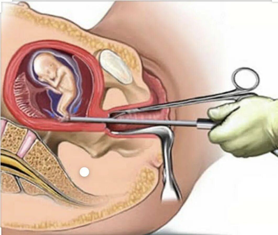 Вакуум аспирация аборт. Вакуумное выскабливание полости матки. Операция выскабливание аборт. Вакуум аспирация матки.