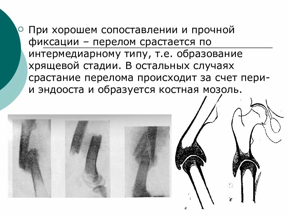 Как понять что перелом срастается ощущения. Стадии сращения переломов костей рентген. срастание отломков при переломе. сращение перелома осуществляется за счет. фазы сращения переломов.