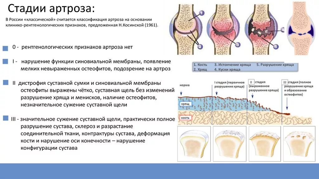 3 й стадии. Классификация остеоартроза коленного сустава. Стадии развития деформирующий остеоартроз. Классификация степени артроза коленного сустава. Рентгенологические стадии остеоартроза тазобедренного сустава.
