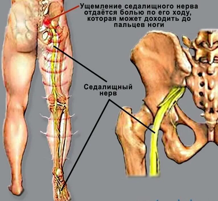 Боль в ногах от бедра до стопы. Анатомия седалищного нерва у человека. Седалищный нерв схема. Заземление седалищный нерв. Седалищный и бедренный нерв.
