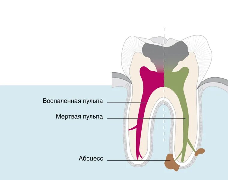 Пульпа. Пульпа