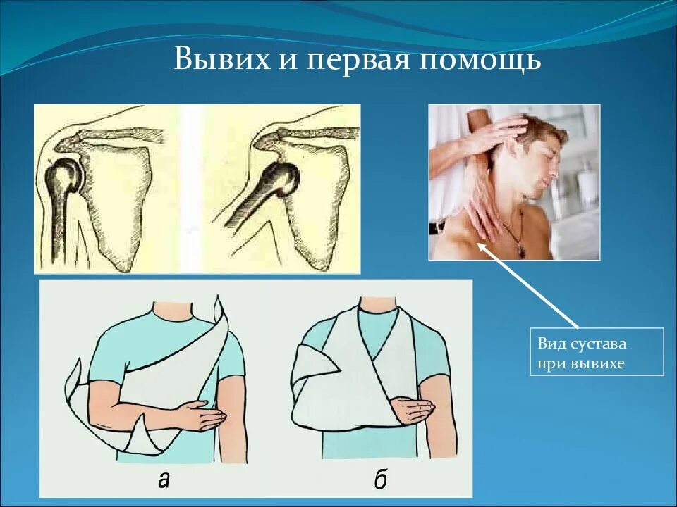 Первая помощь при вывихе плеча. Первая помощь при вывихе. первая помоуь привывихи. первая помощь пр и выаихе. оказание первой помощи при вывихе сустава.
