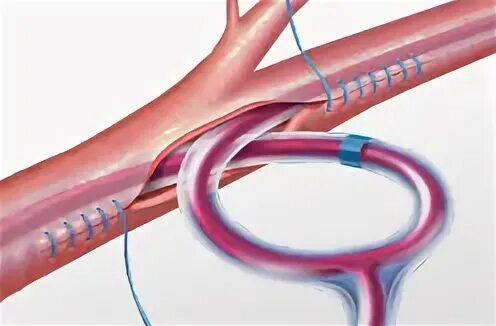 Эндартерэктомия это. Петлевая эндартерэктомия операция. Эндартерэктомия нижних конечностей. Полузакрытая эндартерэктомия. Каротидная эндартерэктомия.