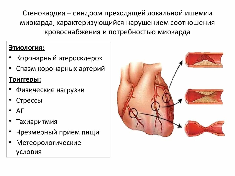 Синдром стенокардии. Стенокардический синдром. миокард характеризуется.