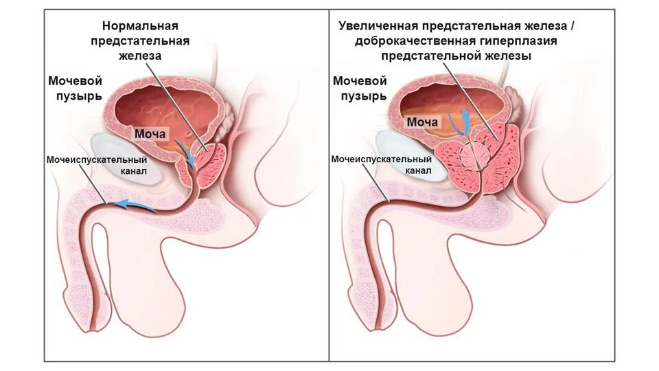 Простата действий. Предстательная железа у мужчин. Секрет предстательной железы у мужчин.