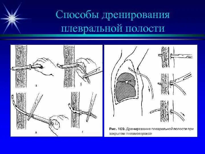 Лечение плевральной полости. Дренаж Бюлау. Пневмоторакс и плевральный дренаж. Троакарный дренаж плевральной полости. Дренирование полости по Бюлау.