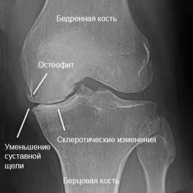 Остеофиты что это такое и как лечить. Остеофит бедренной кости рентген. Остеофиты коленного сустава рентген. Остеофиты на рентгене колена. Рентгеновская суставная щель коленного сустава норма.