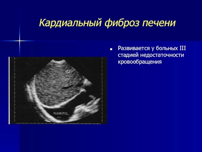 Кардиальный фиброз печени на УЗИ. Перипортальный фиброз по УЗИ.