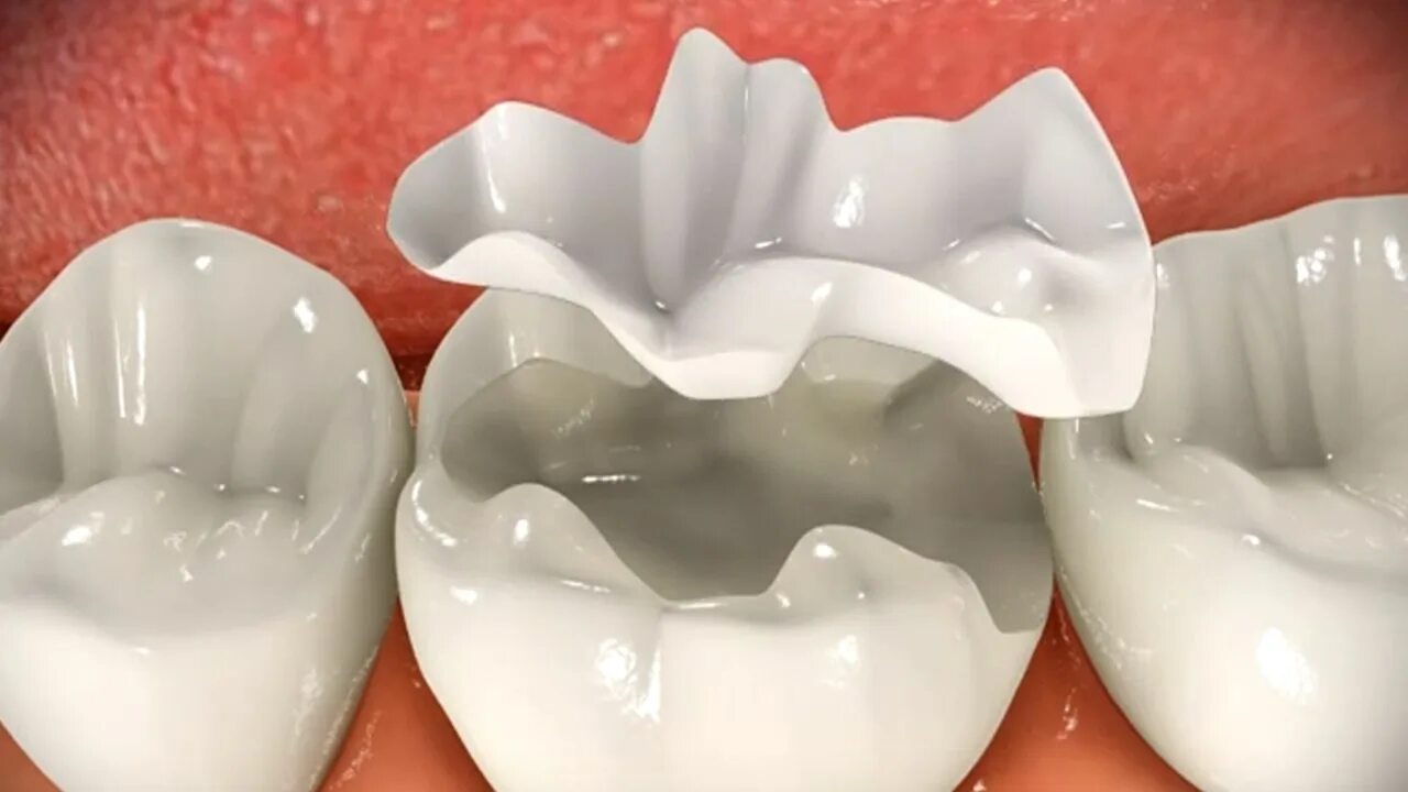 Ортопедическая вкладка. Керамические вкладки emax. Керамические вкладки emax. Цельнокерамическая накладка emax. Ортопедическая вкладка.