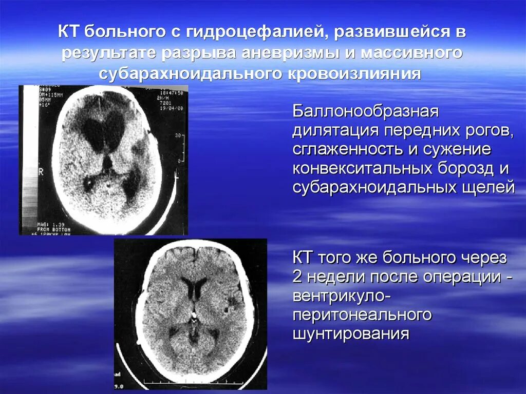 В результате разрыва. Субарахноидальное субарахноидальное кровоизлияние. Субарахноидально-паренхиматозное кровоизлияние кт. Субарахноидальное кровоизлияние межполушарной щели. Мрт субарахноидального кровоизлияния.