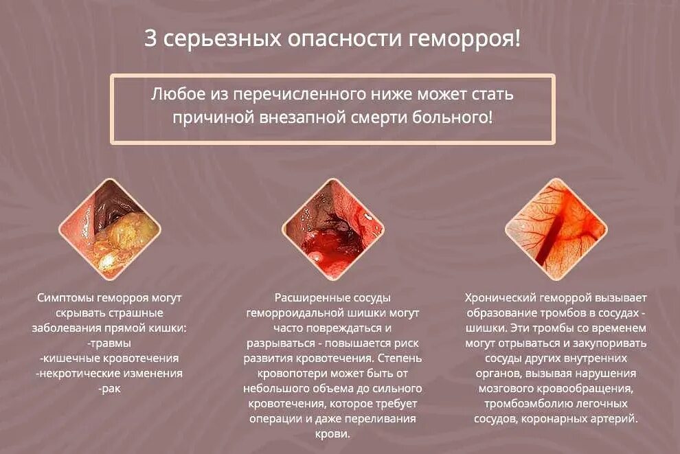 клинические проявления геморроя. симптомы геморроя симптомы геморроя. причины появления геморроя. причины геморроя у женщин. геморрой симптомы причины.