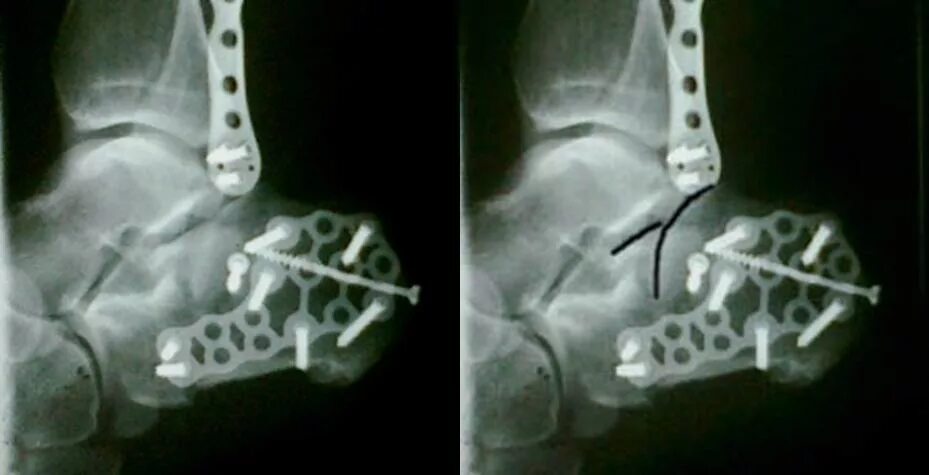 Операция пяточной кости. Остеосинтез лодыжки рентген. Перелом пяточной кости остеосинтез. Операция остеосинтез пяточной кости. Остеосинтез титановой пластиной.