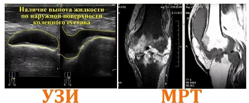 Чем отличается узи от мрт. Гемартроз коленного сустава УЗИ. Гемартроз коленного сустава мрт. Выпот в коленном суставе на УЗИ. Гемартроз коленного сустава кт.