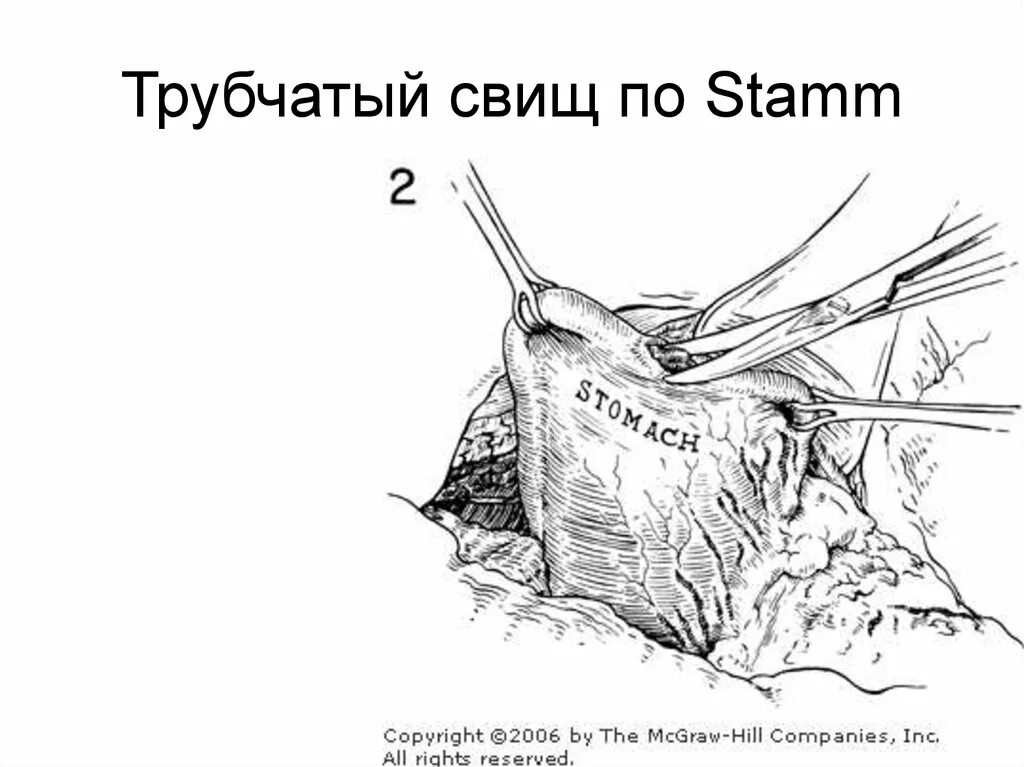 Как правильно пишется свищ. Как правильно пишется свищ