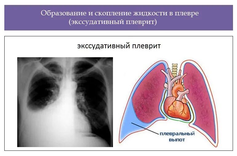 Фибринозный плеврит рентгенограмма. Туберкулезный сухой плеврит рентген. Костодиафрагмальный плеврит. Экссудативный плеврит рентген. Плевральные осложнения