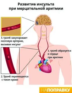 Инсульт после тромба