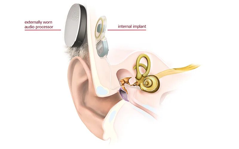 Кохлеарный имплантат Medel. Processor of Cochlear Implant. Cochlear Implant 6. Hear system