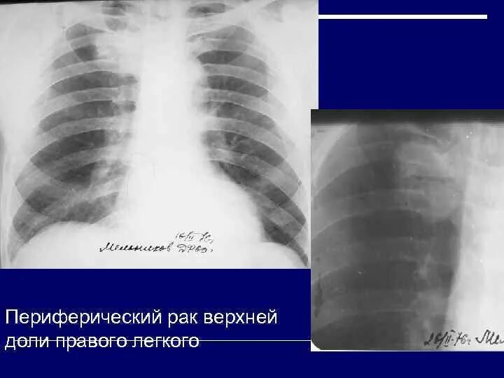 Рак нижней доли. Периферическое образование легкого с6. Периферическое образование s2 левого легкого. Образование верхней доли правого легкого. Периферическое образование верхней доли правого легкого.