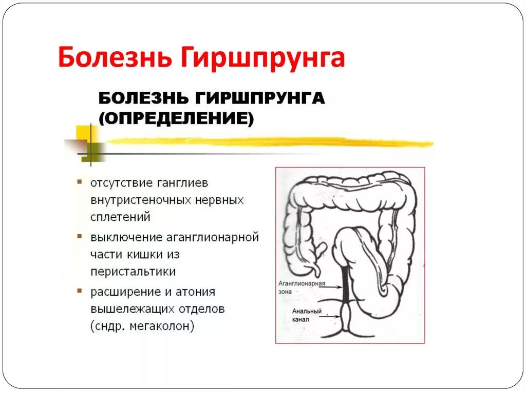 Болезнь гершпрунга у взрослых. Болезнь гиршпрунга этиология патогенез. субкомпенсированная форма болезни гиршпрунга. схема изменений толстой кишки при болезни гиршпрунга. клинические формы болезни гиршпрунга.