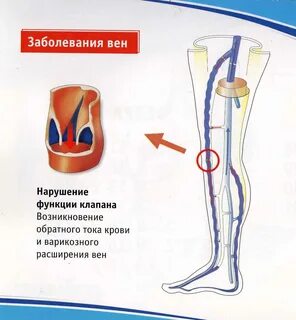 Недостаточность венозного клапана