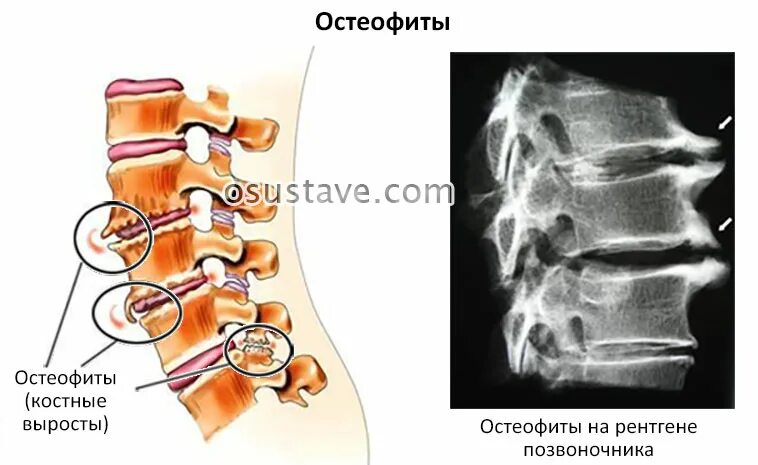 Остеофиты что это такое и как лечить. Остеофиты-l2 ,l3, l4. Краевые остеофиты тел позвонков th5-th9.. Краевые остеофиты тел позвонков th12-s1. Задние остеофиты l4-s1.