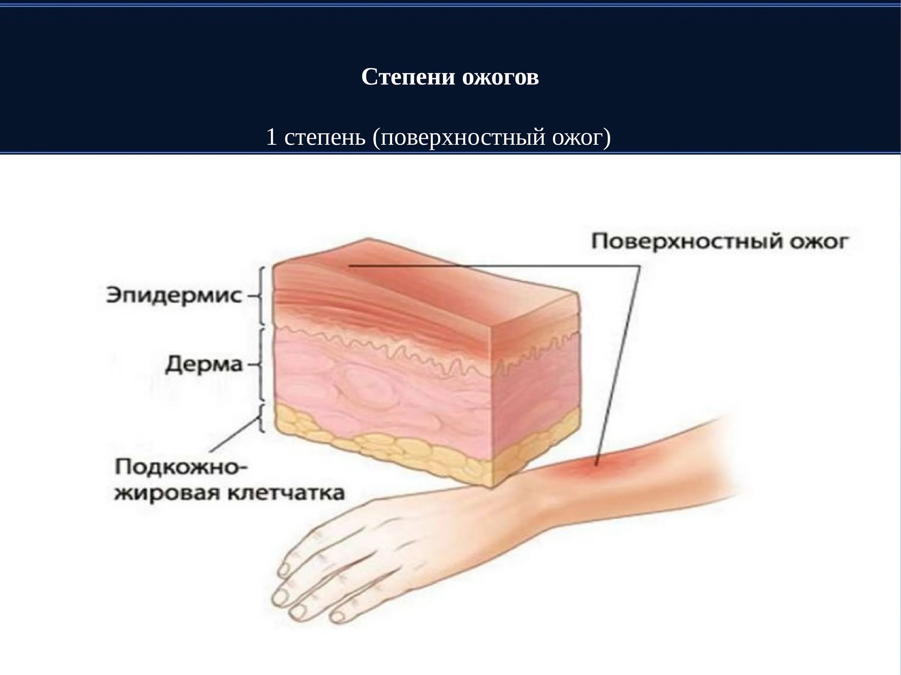 Установите соответствие степени ожога. 1-3 Степень поверхностные ожоги.