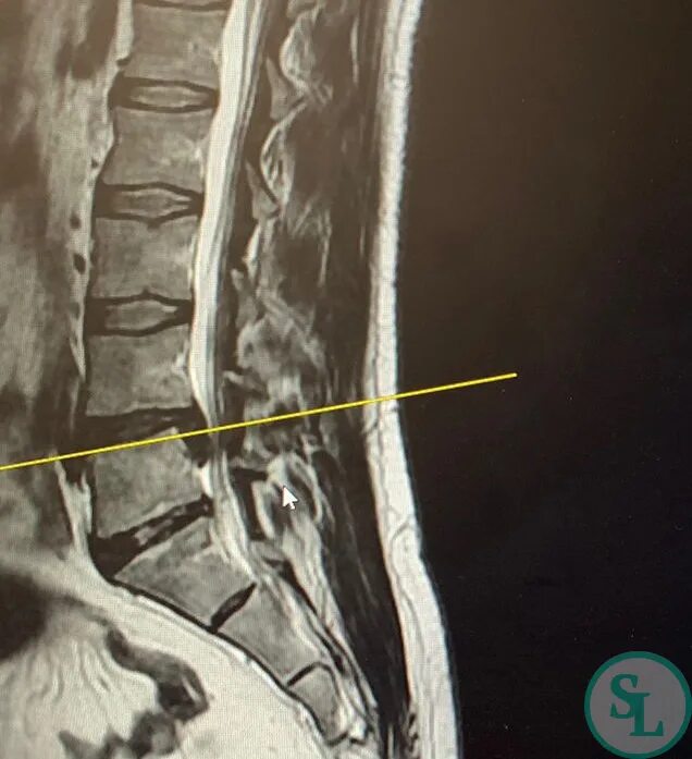 Грыжа диска l5 s1 что это. Секвестрированная грыжа l5-s1. Грыжа л5-s1. Диски l5-s1 в позвоночнике. Грыжа диска l4-l5.