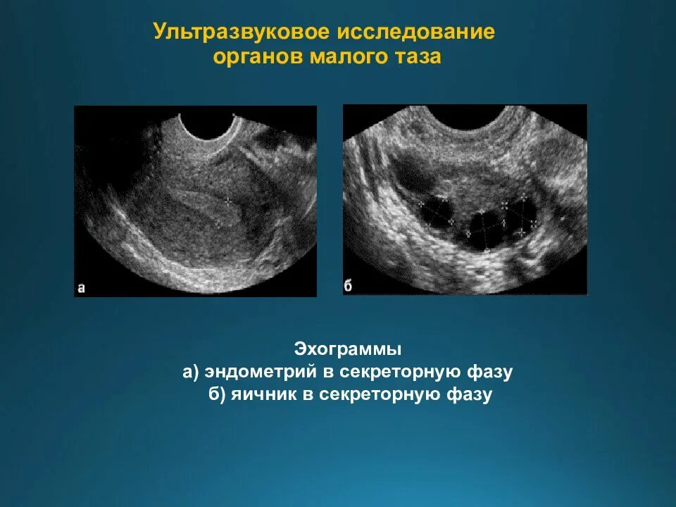 Омт это. Датчик трансвагин узи. Омт расшифровка в медицине. Ультразвуковое исследование малого таза. Омт это.