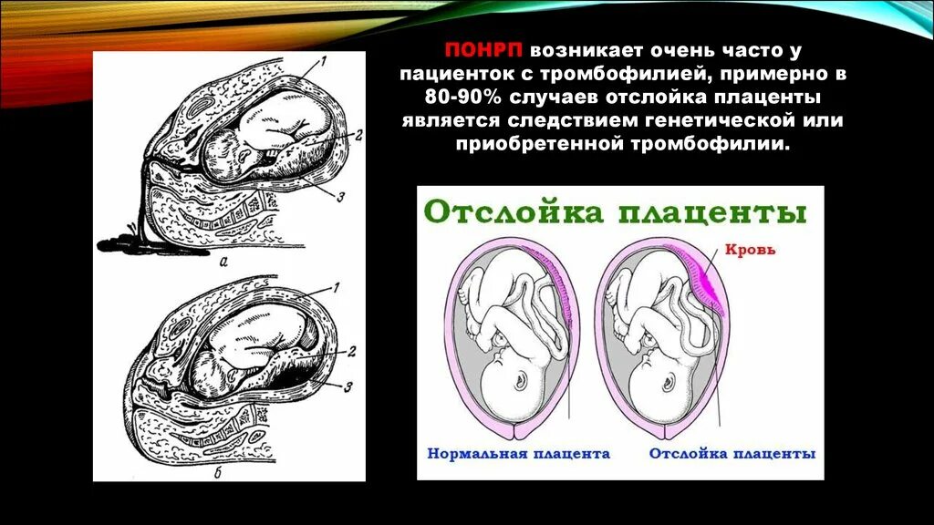 Преждевременная отслойка нормально расположенной плаценты степени. Отслойка плаценты патанатомия. Патогенез отслойки плаценты. 13 неделе беременности плацента