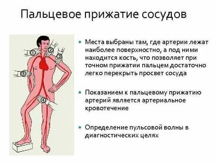 Сколько всего существует прижатия артерии