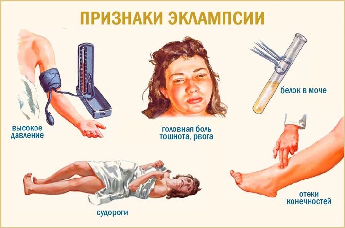 Высокий пульс судороги. Эклампсия симптомы. клонические судороги эклампсия. приступ эклампсии. признаки эклампсии.