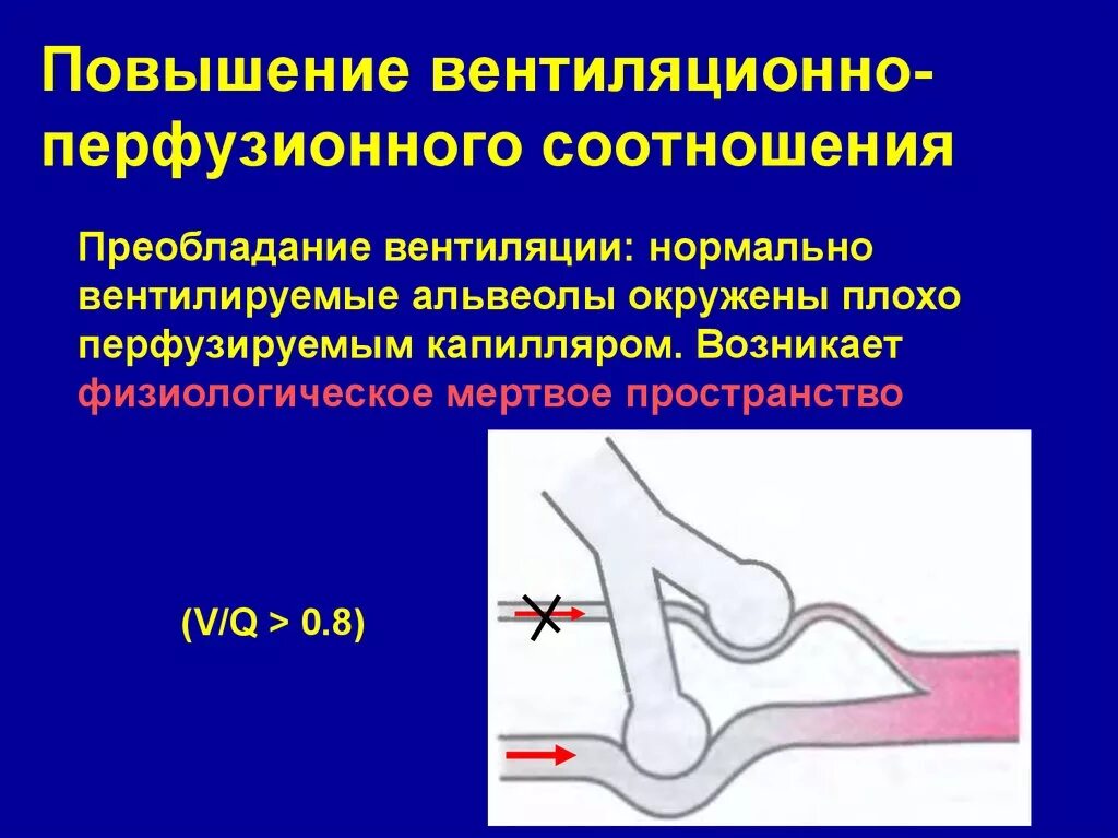 Вентиляционно перфузионное соотношение. Вентиляционно перфузионное отношение физиология. Отношение вентиляции к перфузии. Вентиляционно-перфузионного отношения. Физиологическое мертвое пространство