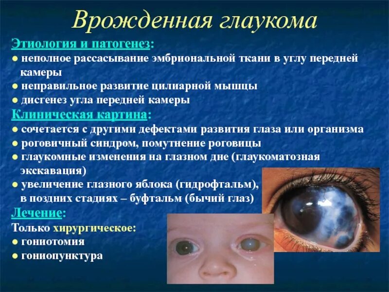 Глаукома глаза причины. Врожденная глаукома этиология. Врожденная глаукома буфтальм. Первичная врожденная глаукома.