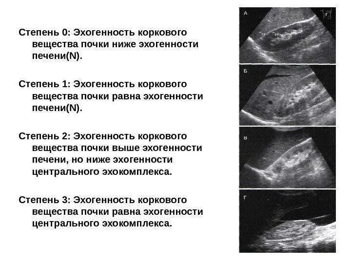 Изменения печени у ребенка. Диффузное уплотнение ЧЛС почек УЗИ. Эхогенность коркового слоя почки в норме. Уплотнение паренхимы почки УЗИ. Эхоструктура неоднородная УЗИ почек.