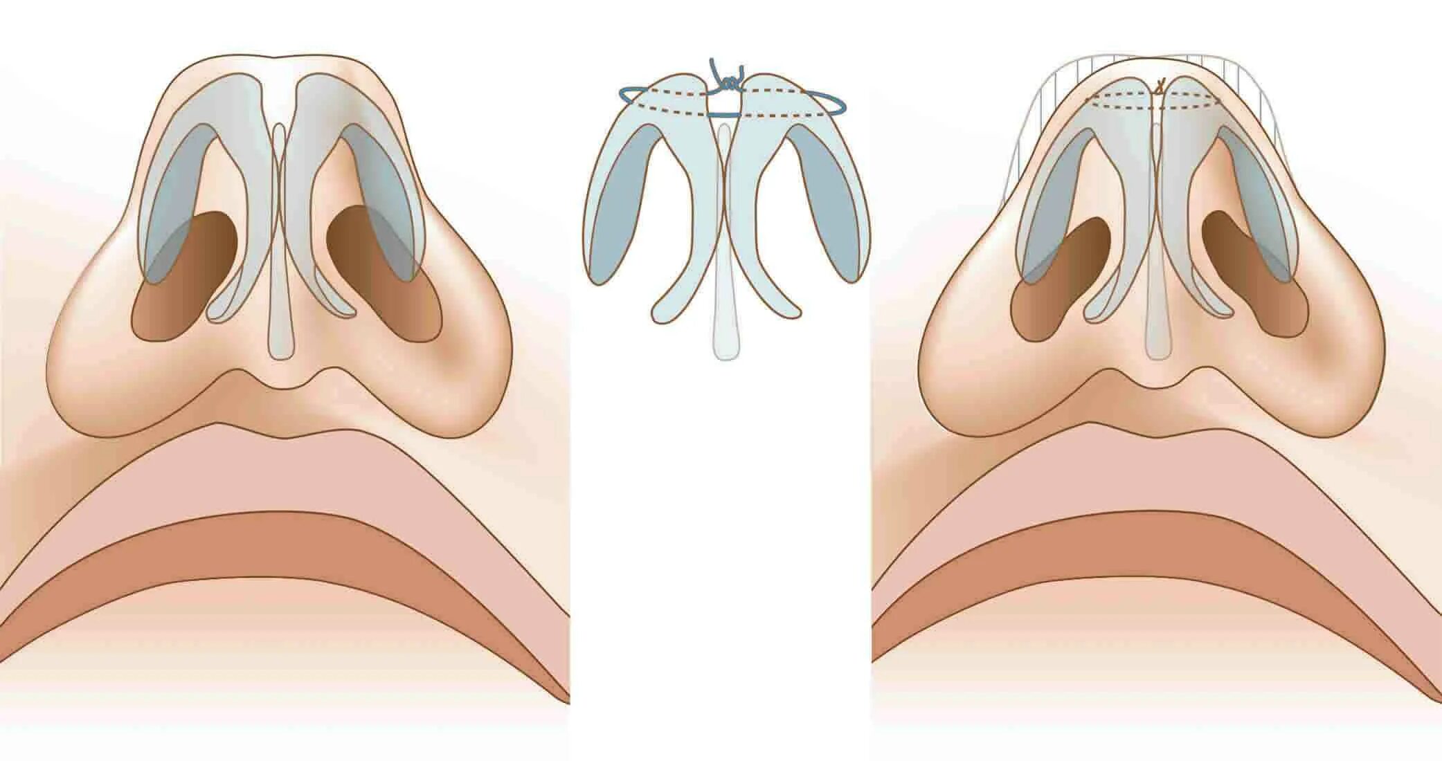 Септопластика носовой перегородки. Операция перегородка носа септопластика. Септопластика – пластика носовой перегородки. Эндоскопическая септопластика носовой перегородки. Перегородка носа без операции