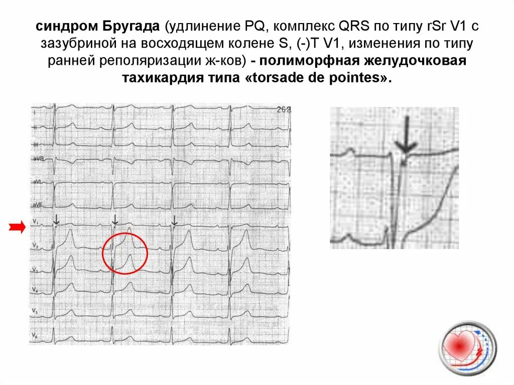 Удлинение комплекса qrs. Синдром бругада 1 типа на экг. комплекс qrs в v1 типа rsr’. зазубрина на восходящем колене зубца s в v1. зазубрина зубца s на экг.