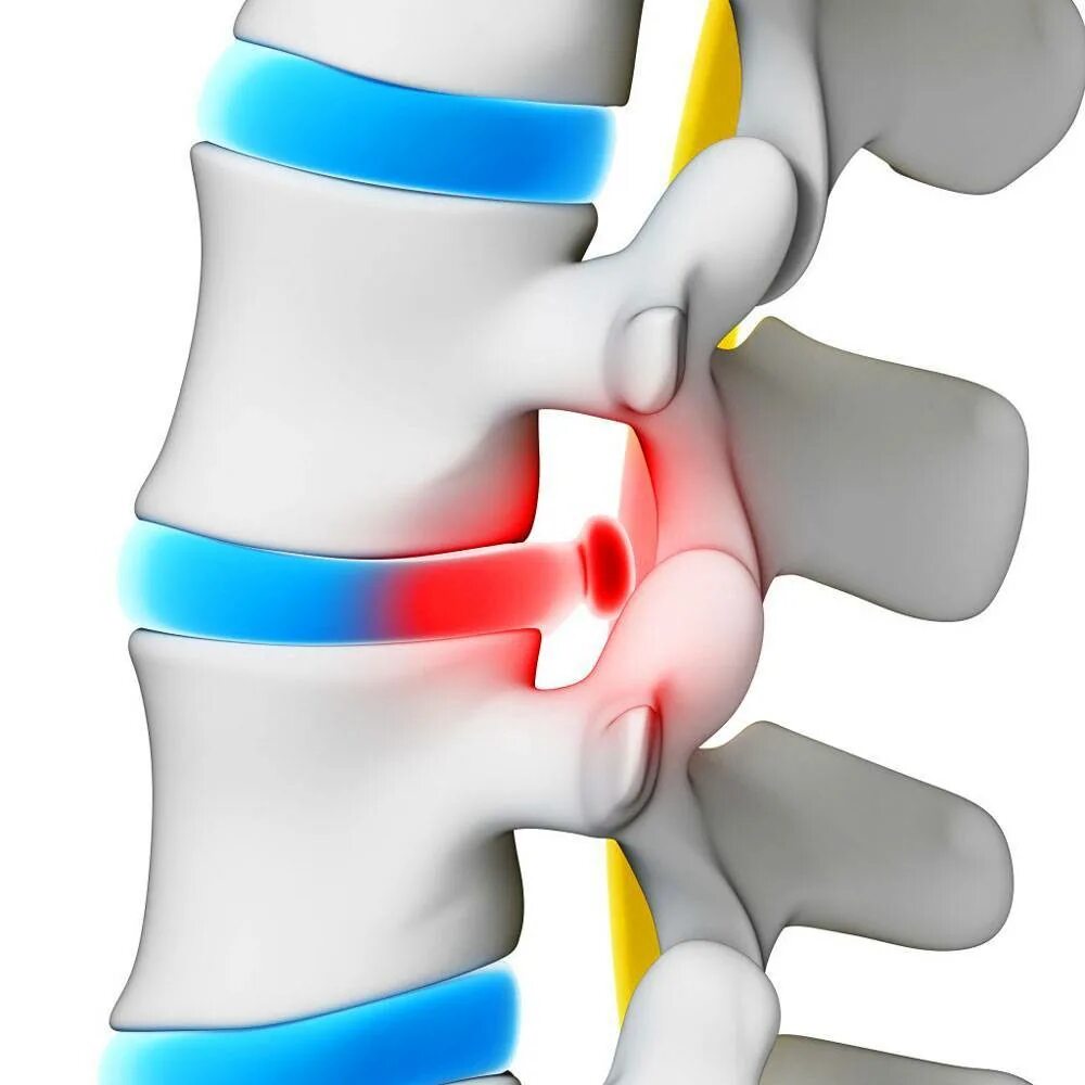 Грыжи дисков поясничного отдела позвоночника. Межпозвоночная грыжа. Грыжи межпозвоночных дисков поясничного отдела. Межпозвонковая грыжа поясничного отдела позвоночника. Секвестрированная грыжа позвоночника.