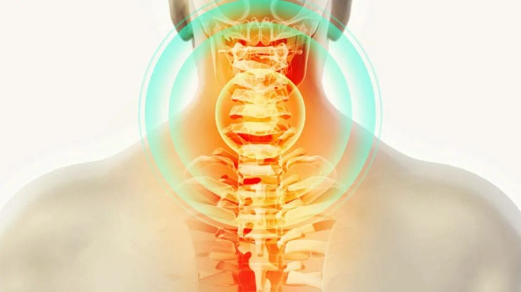 Болит семерка. С6 с7 цервикалгия. Подострая цервикалгия. Дорсопатия цервикалгия что это такое. Вертеброгенная цервикобрахиалгия на фоне остеохондроза.