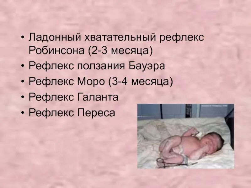 Рефлекс галанта у новорожденных. Рефлекс галанта у новорожденных. Рефлекс галанта у грудничка. Спинальный рефлекс галанта. Рефлекс галанта и переса у новорожденных.