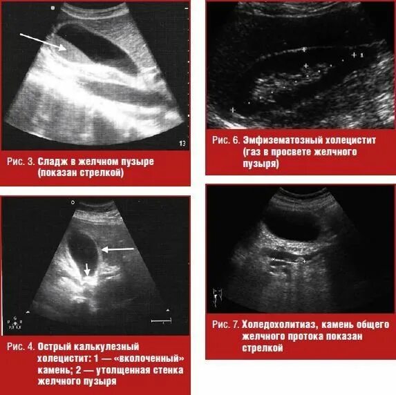 Сгустки в желчном пузыре. Сладж феномен желчного пузыря. Билиарный сладж в желчном пузыре. Взвесь в желчном пузыре на УЗИ.